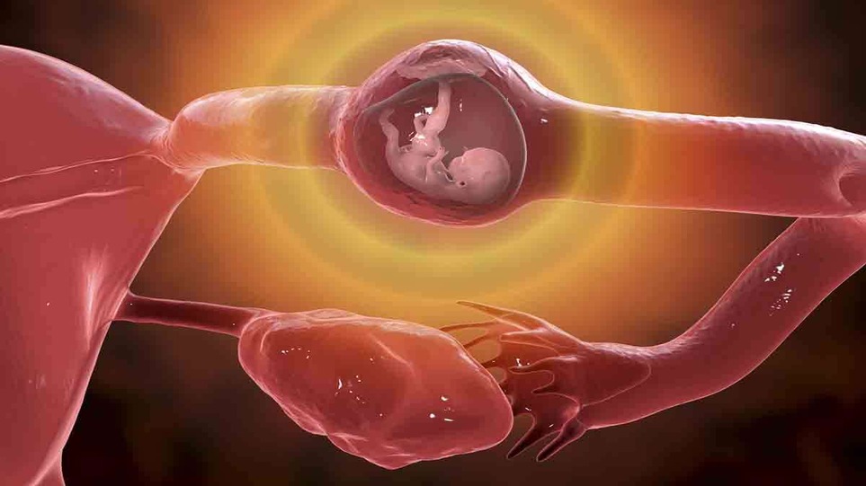 بارداری خارج رحمی لوله‌ای